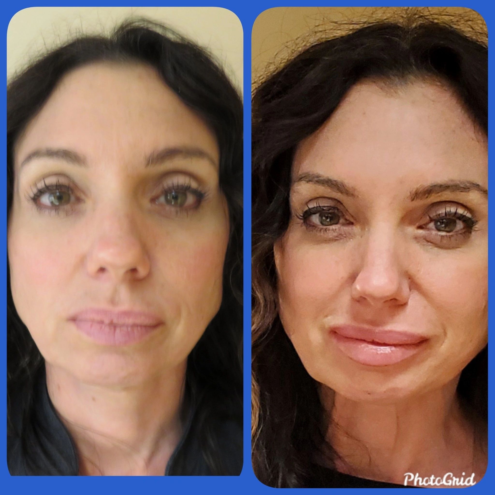 A Fix for Aging Lips